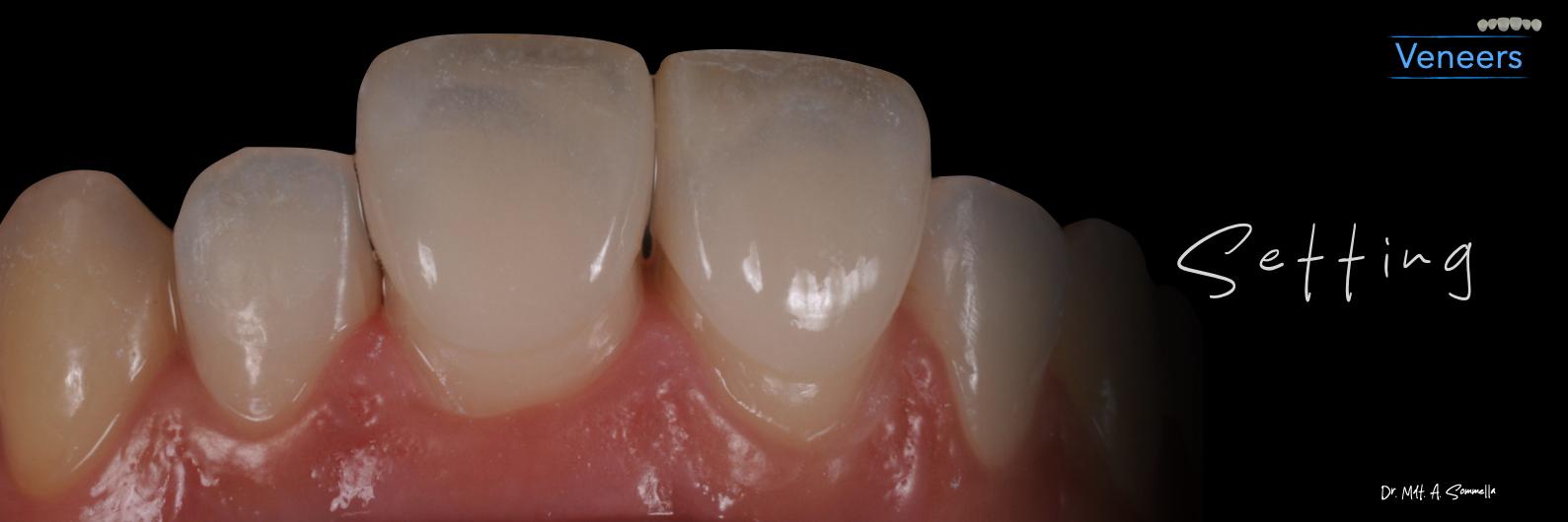 Lavorazione odontotecnica dell'Odt. Paolo Miceli — immagine 2