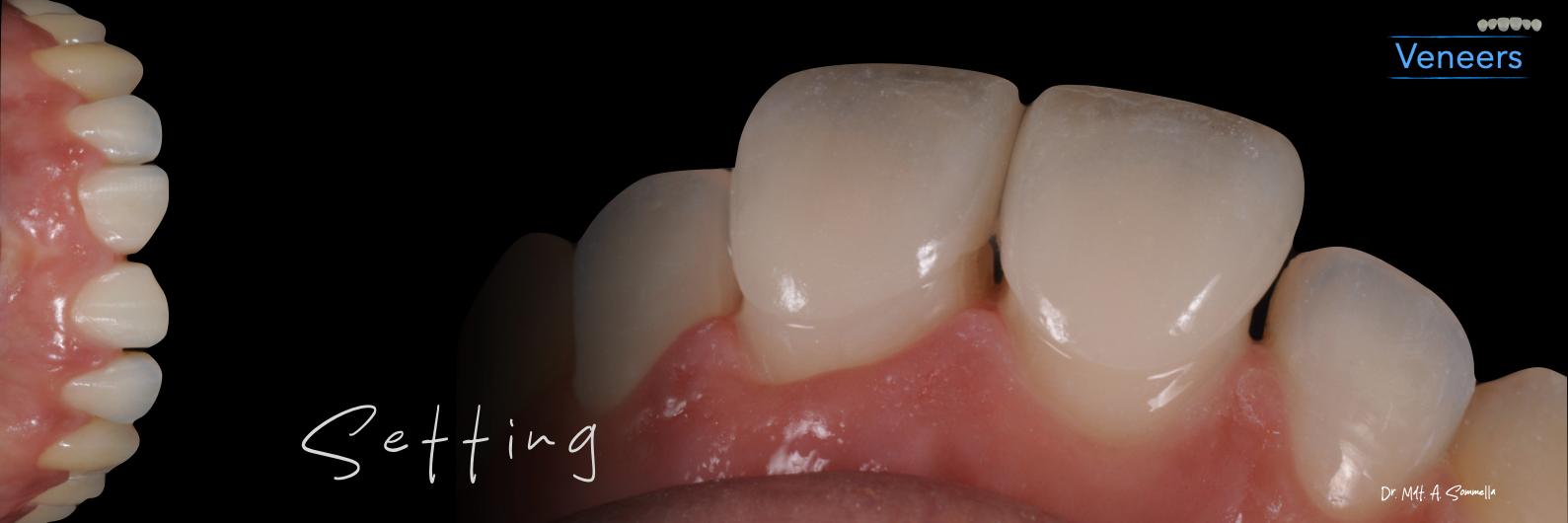 Lavorazione odontotecnica dell'Odt. Paolo Miceli — immagine 3