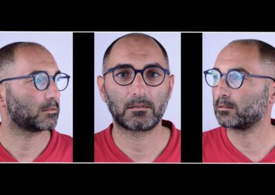L’approccio al caso richiede manovre particolarmente attente poiché il paziente presenta una scoliosi strutturale, condizione che richiede il rilevamento di una dimensione verticale armonica con il suo status scheletrico e rispettosa delle sue curve patologiche