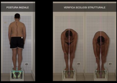 Inseriti e caricati gli impianti inferiori, immediatamente dopo la consegna del provvisorio con le nuove altezze, si nota l’istantanea riorganizzazione del comparto capo-collo