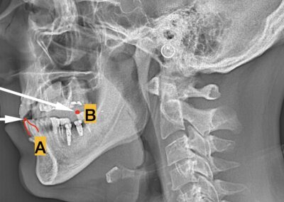 Confermate anche radiograficamente le altezze, il professionista indica con precisione le determinanti del nuovo piano occlusale: la posizione dell’incisivo centrale inferiore (PUNTO A) e la battuta inferiore della palatina del sesto superiore (PUNTO B ). Su queste indicazioni il laboratorio effettuerà il montaggio della calotta indicata dal clinico.