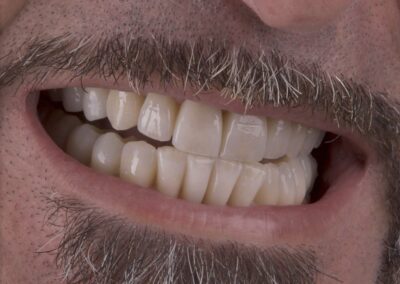 Rapporto labbra denti del caso terminato. Si è raggiunto un buon compromesso morfologico e funzionale. Ciò ci ha consentito di realizzare degli elementi dall’aspetto veritiero senza nessun compromesso funzionale.