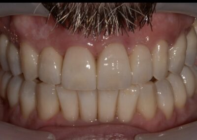 Nel settore frontale si è realizzato un ponte da 13 a 23 con due elementi intermedi gestiti dal professionista con tecnica ovoid. Nonostante la difficoltà si evidenzia una buona estetica ed una mimesi accettabile.